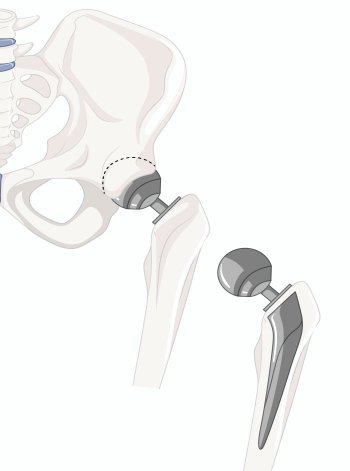 Arthroplasty (Joint Replacement)